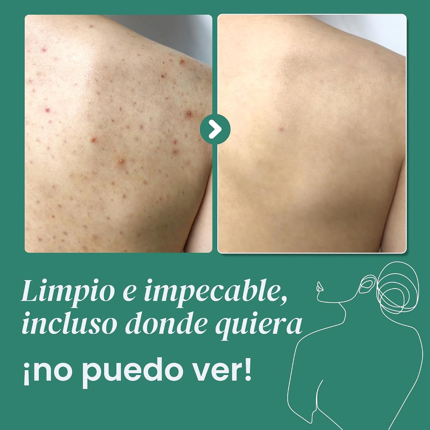 GEL DE BAÑO ANTI ACNE [PV1-WHATSAPP-MAXTRENDSHOPS]