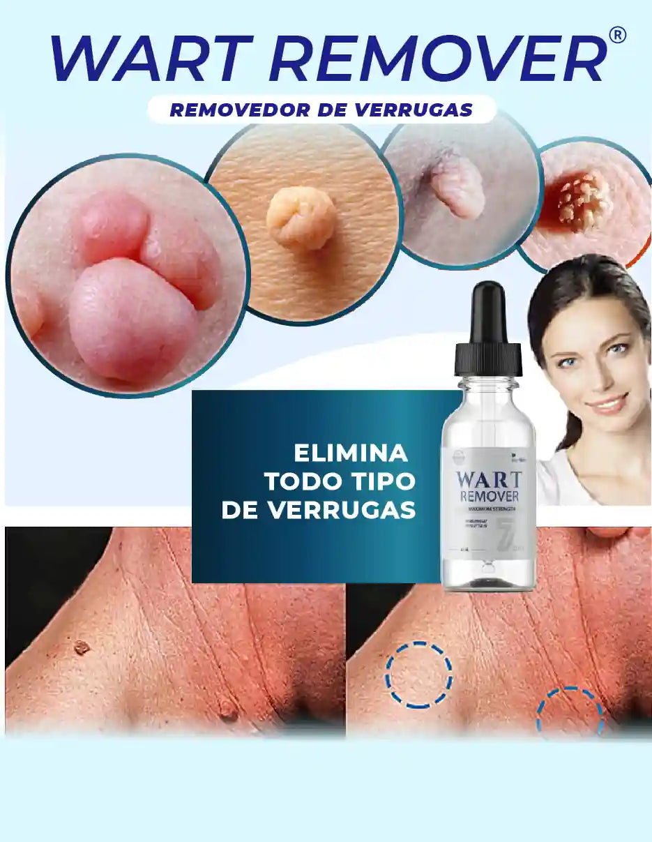 REMOVEDOR DE VERRUGAS WART REMOVER [PV1-META-MAXTRENDSHOPS]