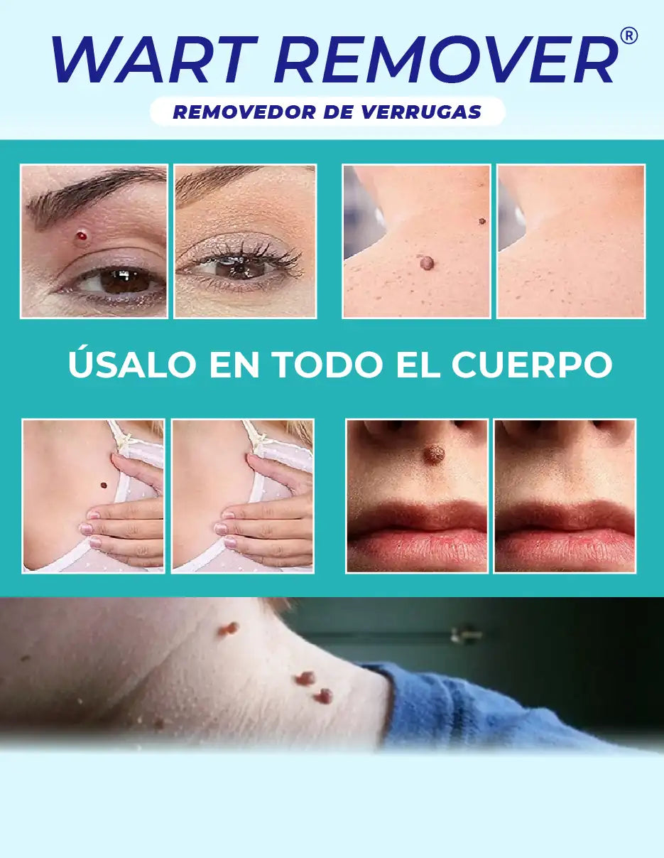 REMOVEDOR DE VERRUGAS WART REMOVER [PV1-META-MAXTRENDSHOPS]